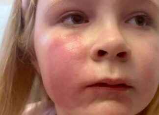 Lip Gloss Burned Daughter’s Face – Safety Tips for Parents lip-gloss-burned-daughters-face-safety-tips-for-parents